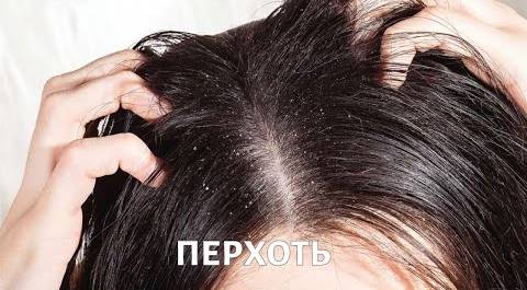 Заболевания кожи головы: перхоть, алопеция, педикулез