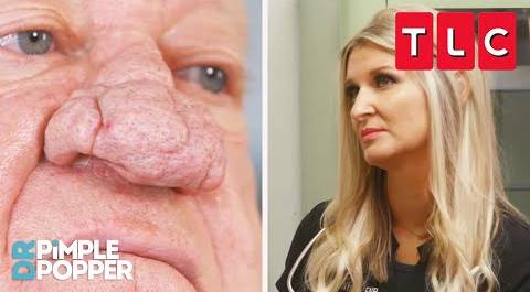 This Man Has a Nose the Size of a Plum! | Dr. Pimple Popper | TLC