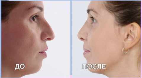 Перезагрузка: Изменение формы носа и увеличение груди