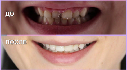 Перезагрузка: Что делать с пломбами или со сколами в передних зубах